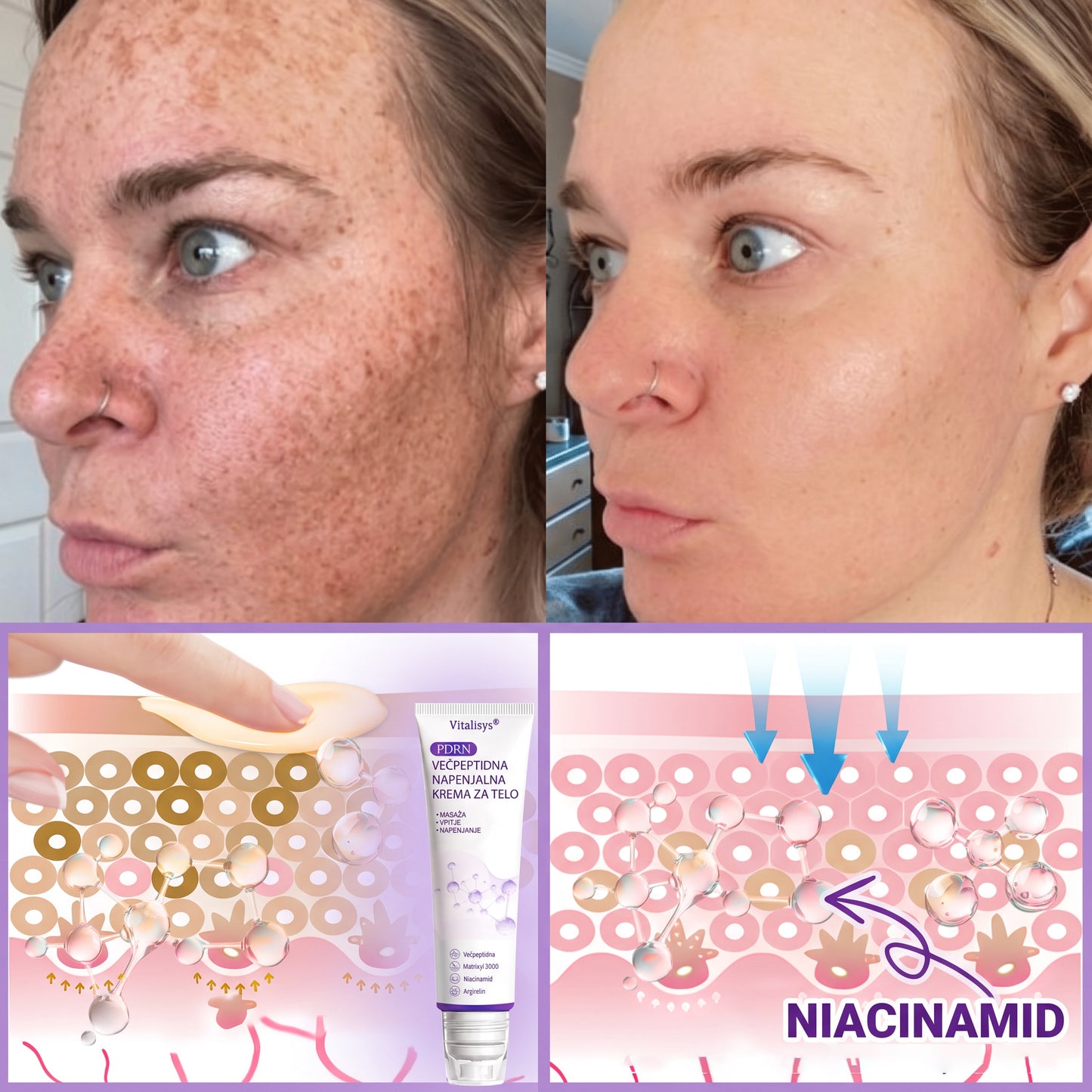 🇸🇮 Dermatološko priporočeno🥇 | 🍇Vitalisys® PDRN multi-peptidna masažna telesna kreme – Proti staranju, vlažilna, učvrstitvena, obbujevalna, izravnalna, za odstranjevanje aken in madežev, odstranjevanje bradavic in materinih znamenj, lajšanje luskavice.❤️