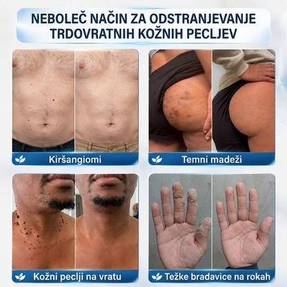 🇸🇮 Visokokakovosten slovenski izdelek, hitra domača dostava | MURWON® 🏠 Mikroiglični obliži za zmanjšanje videza kožnih nepravilnosti 🍉 (Za kožne izrastke, bradavice, znamenja, pigmentne madeže in druge vidne kožne nepravilnosti.) ❤️
