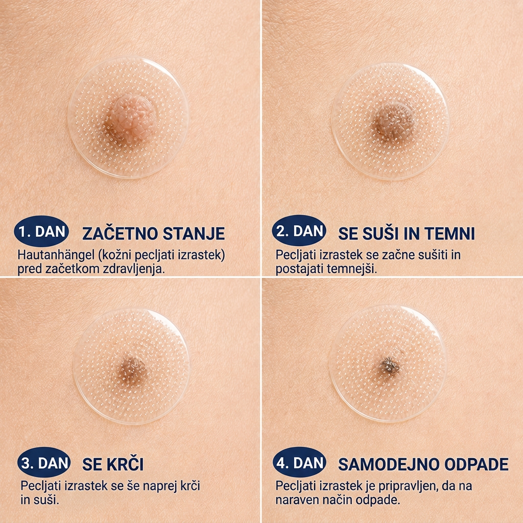 🇸🇮 Visokokakovosten slovenski izdelek, hitra domača dostava | MURWON® 🏠 Mikroiglični obliži za zmanjšanje videza kožnih nepravilnosti 🍉 (Za kožne izrastke, bradavice, znamenja, pigmentne madeže in druge vidne kožne nepravilnosti.) ❤️