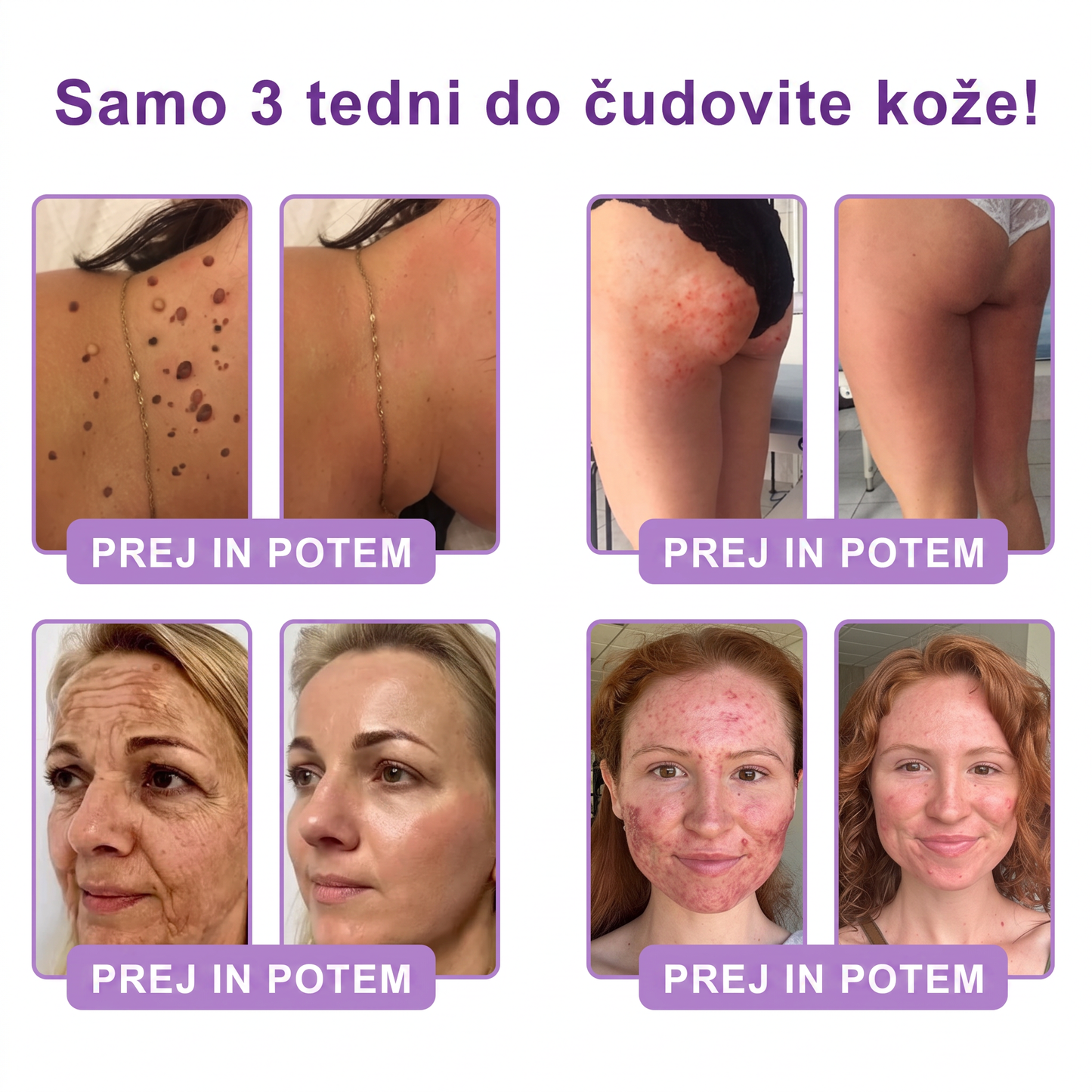 🇸🇮 Dermatološko priporočeno🥇 | 🍇Vitalisys® PDRN multi-peptidna masažna telesna kreme – Proti staranju, vlažilna, učvrstitvena, obbujevalna, izravnalna, za odstranjevanje aken in madežev, odstranjevanje bradavic in materinih znamenj, lajšanje luskavice.❤️