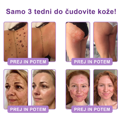 🇸🇮 Dermatološko priporočeno🥇 | 🍇Vitalisys® PDRN multi-peptidna masažna telesna kreme – Proti staranju, vlažilna, učvrstitvena, obbujevalna, izravnalna, za odstranjevanje aken in madežev, odstranjevanje bradavic in materinih znamenj, lajšanje luskavice.❤️