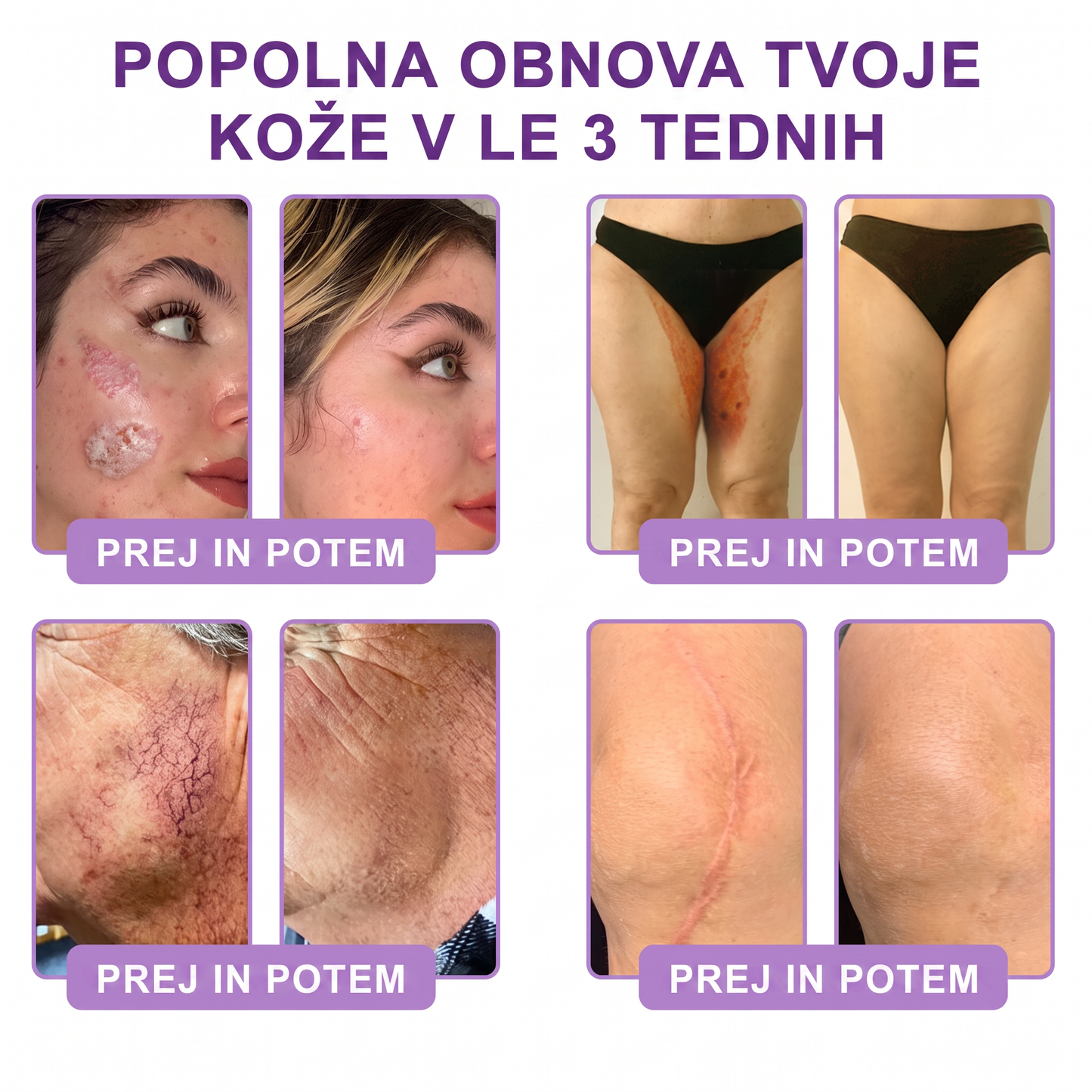 🇸🇮 Dermatološko priporočeno🥇 | 🍇Vitalisys® PDRN multi-peptidna masažna telesna kreme – Proti staranju, vlažilna, učvrstitvena, obbujevalna, izravnalna, za odstranjevanje aken in madežev, odstranjevanje bradavic in materinih znamenj, lajšanje luskavice.❤️